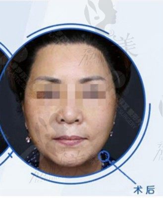 40+泪沟深怎么办？来普罗菲耳做小切口三重提升效果好！