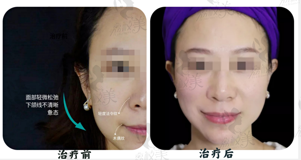 杭州圣茜欧洲之星·FOTONA 4D可以祛除法令纹，是真的吗？