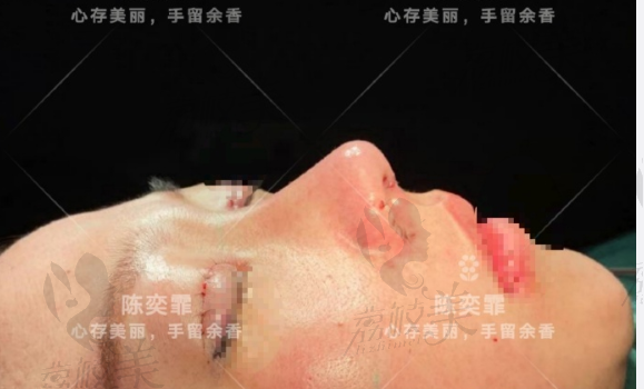 注射玻尿隆鼻失败怎么办?陈奕霏的半肋隆鼻修复不踩坑