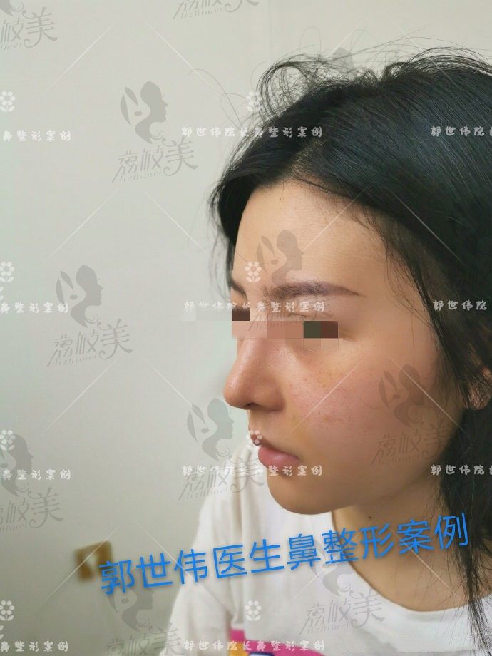 成都天后郭世伟的半肋鼻综合手术改变低鼻梁的恢复过程