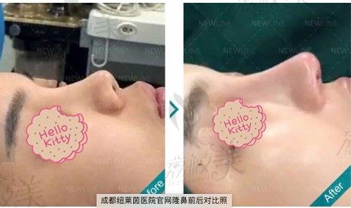 成都纽莱茵郑在祐膨体隆鼻和华美徐鹏肋软骨隆鼻哪个技术好？