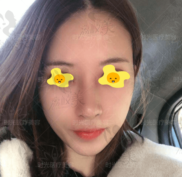 在桂林时光做的综合隆鼻，术后60天恢复效果来了！