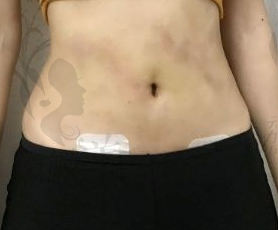 韩国The整形外科腰腹环吸轻松告别腹部赘肉，变身小蛮腰！