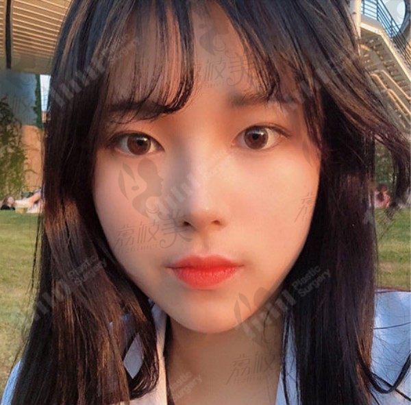 韩国1mm整形外科眼鼻面部综合整形案例，变身精致小仙女！