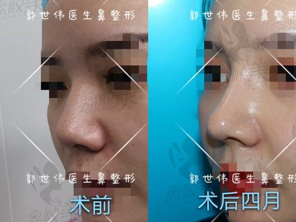 注射隆鼻失败了怎么办?这有一组郭世伟的鼻修复术后效果