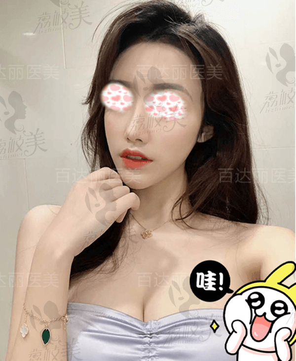 找重庆隆鼻的进来,奉上一个百达丽的肋软骨隆鼻经历分享