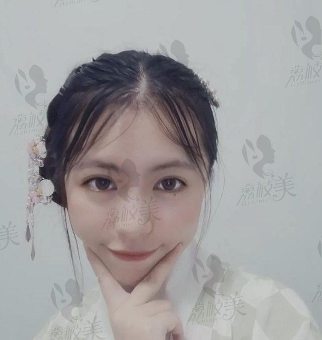 长沙美奥口腔医院找李森院长做钢丝矫正日记，看1年中虎牙不见有了下巴