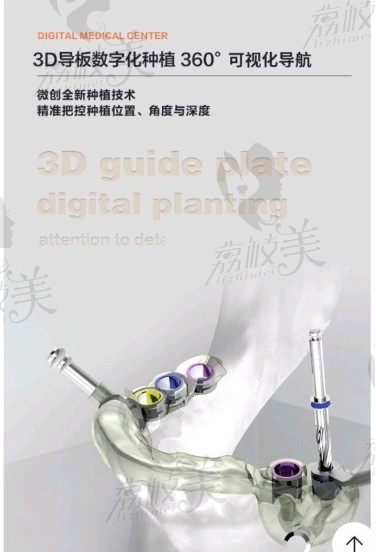 【家庭牙医 ·大川齿科】法国安卓健微创数字化3D导板种植牙
