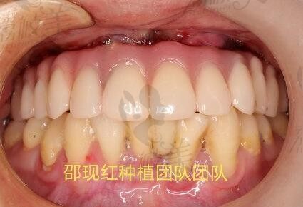 杭州国大口腔邵现红做即刻种植牙效果怎么样？内附案例