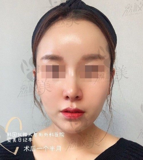 怎么拯救做坏的鼻子！亲身分享我在韩国的鼻整形修复之路!