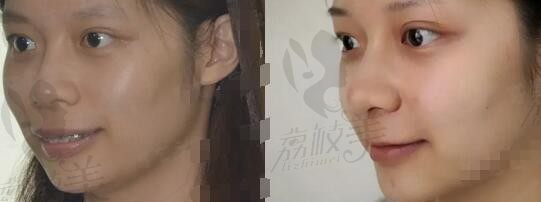 骨性+牙性凸嘴，找广州中山大学光华口腔杨小平做正颌咋样