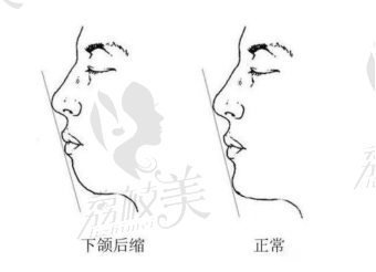 上海华美V-LINE下颏形成术,是怎么截骨的,能改善下巴后缩吗?