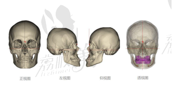 广州广大做颌面手术怎么样,看何锦泉的3D导板改脸型技术!