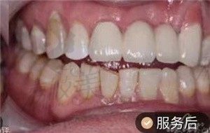 洛阳济仁口腔，47岁周先生前牙区种植修复$手术后效果