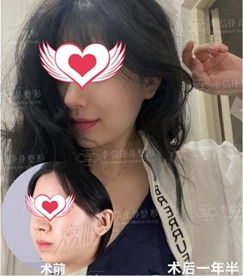 隆鼻用膨体好还是自体软骨好,深圳星妍整形李信锋院长通过日记介绍膨体隆鼻
