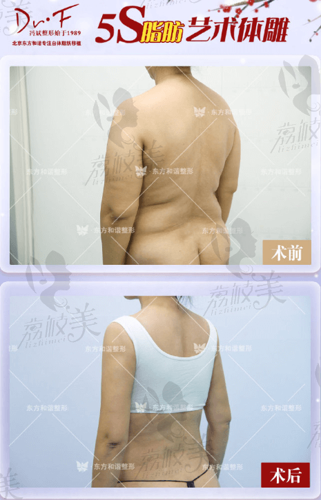 针对北京哪个医院抽脂好，把大腿抽脂不错的都介绍给你吧