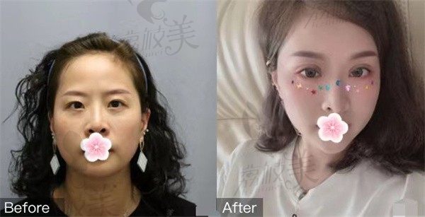 SVF全面部黄金胶填充怎么样？深圳阳光SVF黄金胶效果对比图，看效果图