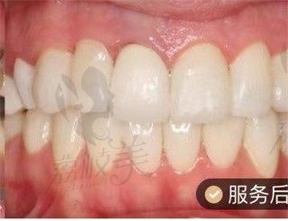 郑州盛禾口腔做的全口贴面+冠修复，看患者术后的修复效果，美观了很多