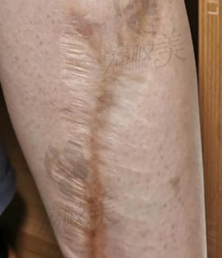 武汉正璞医疗小腿凹陷疤痕修复方法是什么？可以修复平吗？价格大概多少钱？