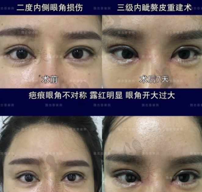 北京丽星翼美魏志香院长使用包眼角修复手术解决双眼皮露红
