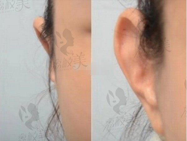 上海贴发耳矫正哪里可以做?伯思立张权玻尿酸注射贴发耳矫正多少钱？
