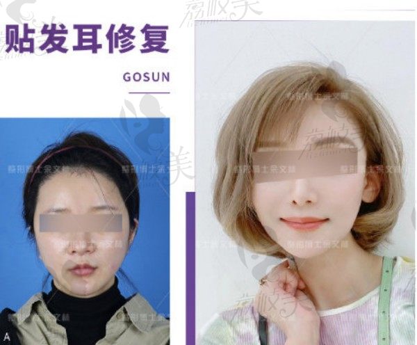 广东高尚余文林与成都淳渼玉颜刘玉辉贴发耳矫正哪个效果好？术后会不会留疤？
