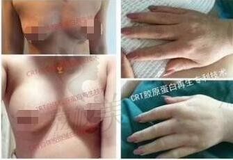 胸部不饱满、下垂找北京凯润婷白晋博士做Crt自体脂肪丰胸靠谱吗？有后遗症？