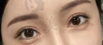 双眼皮宽变窄需要去皮吗?看哈尔滨斯美诺张宁眼修复效果！