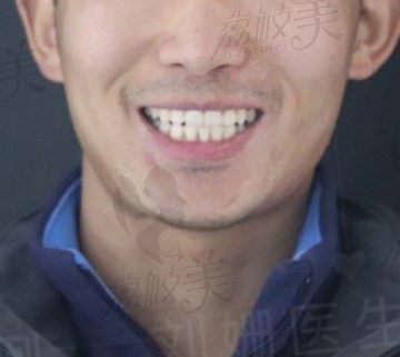 成都新桥口腔刘珊医师用时代天使隐形矫正改变了我下巴后缩、牙列拥挤、门牙前突的症状