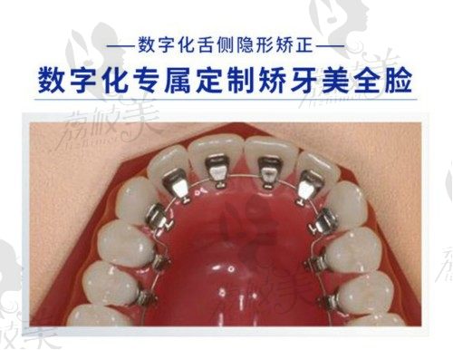 福州维乐口腔医院正畸价格贵吗？舌侧隐形矫正改善突嘴龅牙|深覆合|地包天