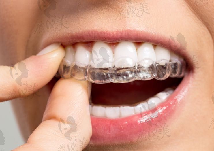 牙齿矫正需要多长时间，有年龄限制吗？答案是40岁还有人做口腔矫正