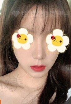杭州格莱美汪云峰做的鼻综合真不错，灵动美鼻术后即刻与130天后效果分享