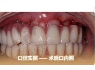 在北京中诺口腔找粟伟做完立得用数字化全口种植牙,58岁女士年轻了10岁