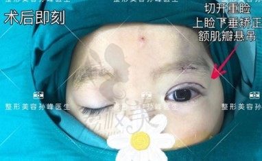 3岁小朋友的先天性眼睑下垂矫正成功，西安国际孙峰功不可没