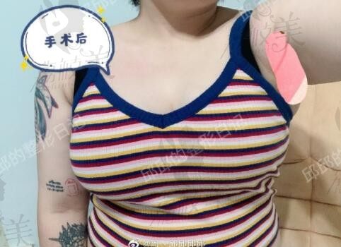 胸大有什么办法缩小吗？在重庆星荣整形做完巨乳缩小手术G