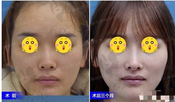 福州海峡薛克乾医生综合隆鼻修复，重塑隆鼻修复后形态更稳定