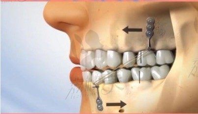 牙齿矫正打骨钉的作用是什么？支抗钉矫正适用哪些牙齿问题？