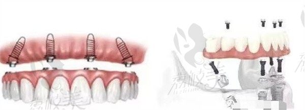 治疗牙齿缺失的修复方法都有啥？广州穗华即刻种植牙技术仅用半天拥有健康牙齿