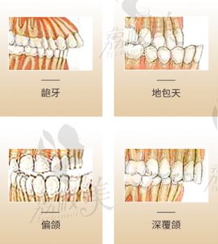 廣州時光侯振杰正牙怎么樣？可快速矯正骨性齙牙/地包天挺可靠