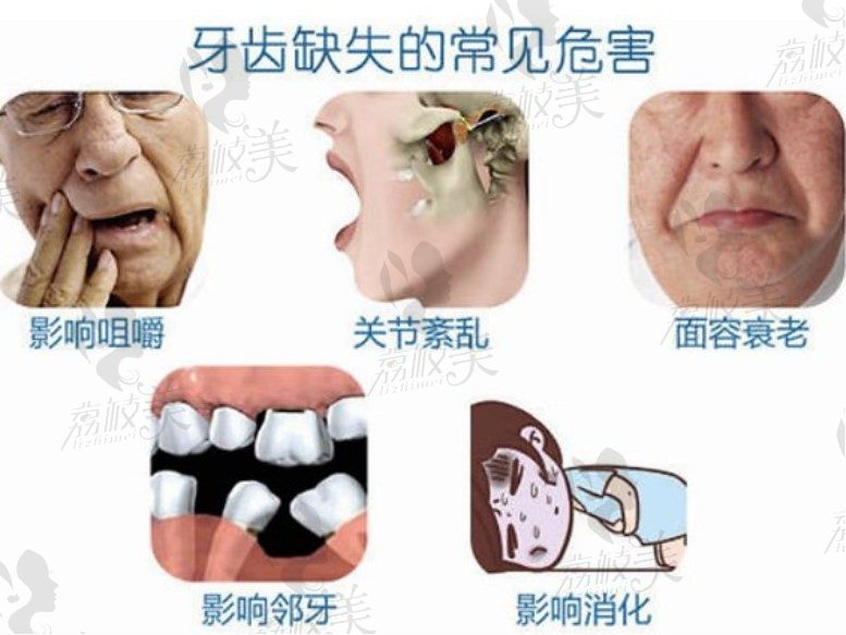 珠海九龙口腔：缺牙不补有什么影响,种植牙和假牙的效果真的差不多吗