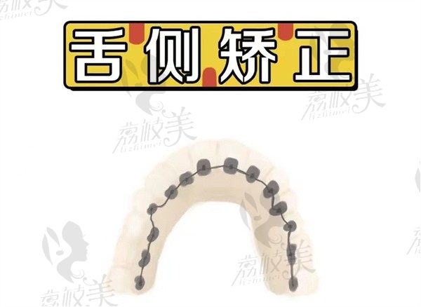 舌侧牙套和隐形牙套哪个好？杭州开璞口腔舌侧矫正的效果好吗？优缺点都有啥？