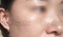 怎样淡化雀斑非常有效果？看我在天津坤如玛丽60天的真实祛斑效果！