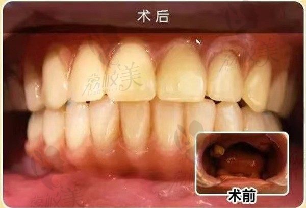 湘潭赖尔口腔张先生无痛全口种植牙，术后反馈：吃啥都香睡眠质量也改善了
