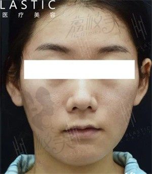广州宸山超光子嫩肤升级版，M22-AOPT超光子嫩肤治疗前后对效果明显！