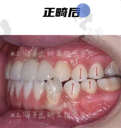 口内有烤瓷牙可以做矫正吗？常州魏东口腔魏东医师附矫正病例说明