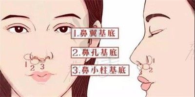 广州曙光玻尿酸膨体、硅胶填充解决鼻基底凹陷，看术后填充效果怎么样？