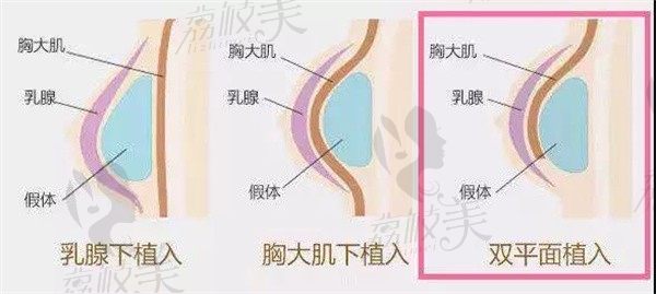 在广州曙光医院做假体隆胸，都要经历哪些步骤？优势有哪些？