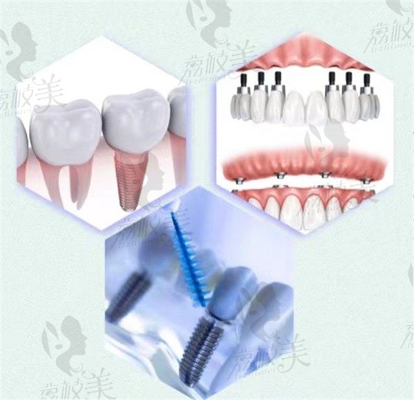 想要去种牙，种植体要怎么选择？西安惟美齿科三点教你选择。