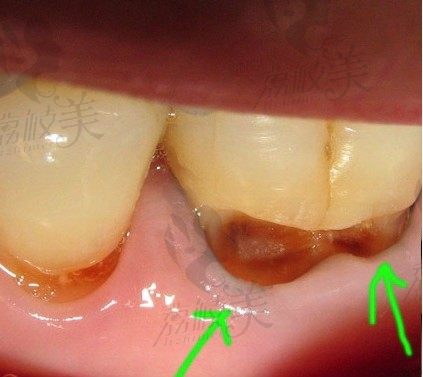牙根处出现横槽怎么修补？补牙放排龈线有什么作用？