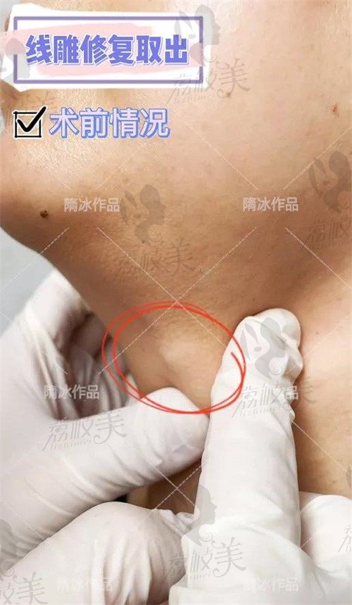 手术前